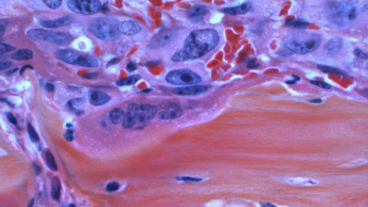 Cât timp poți trăi cu cancer de prostată în stadiu avansat? Povestea bărbatului care schiază și navighează după 14 ani de la diagnostic
