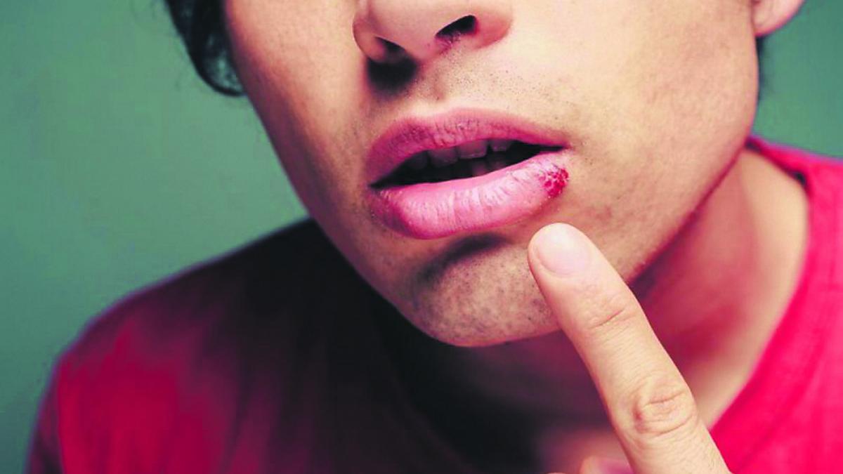 Cum tratezi un herpes cu ingrediente naturale: 5 remedii casnice eficiente