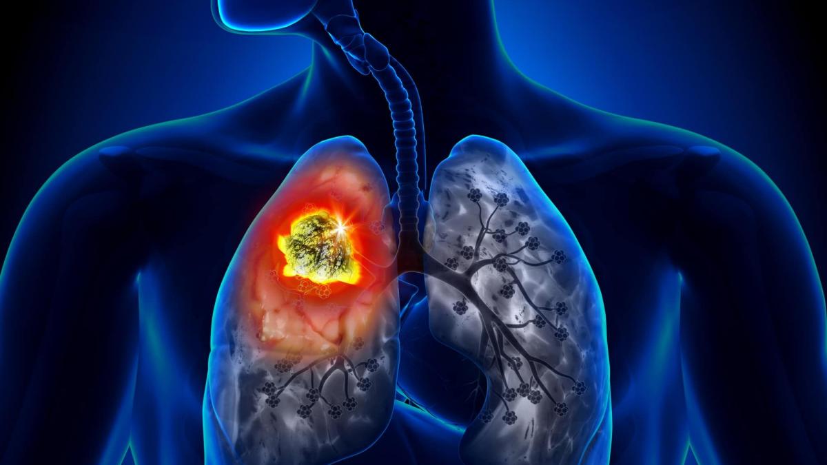 Cancerul pulmonar, în creștere alarmantă. Ce drepturi au pacienții români pentru a-l depista la timp