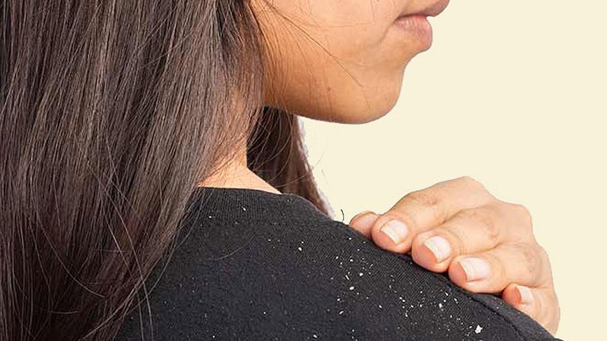 Metode naturale care te ajută să scapi rapid de mătreață