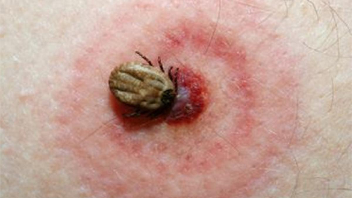 Cum recunoști înțepăturile de insecte, ce trebuie să faci și când trebuie să mergi la medic
