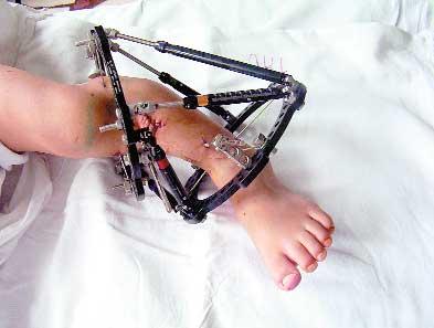 Modelarea piciorului - Chirurgie ortopedică modernă