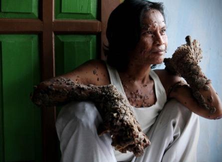 Omul-copac şochează lumea! 18385608