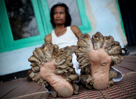 Omul-copac şochează lumea! 18385609