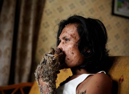 Omul-copac şochează lumea! 18385610