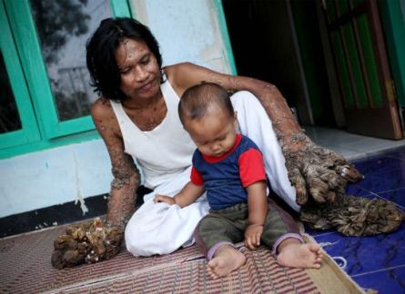 Omul-copac şochează lumea! 18385611