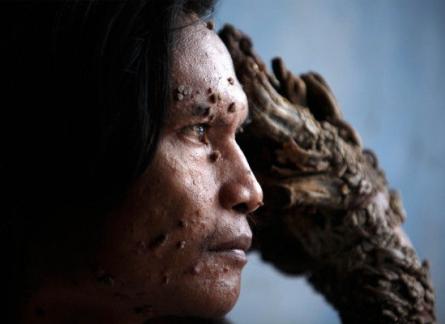 Omul-copac şochează lumea! 18385612