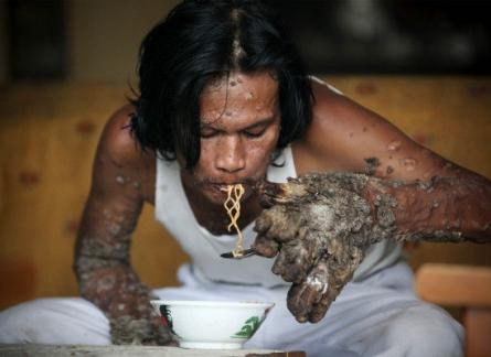 Omul-copac şochează lumea! 18385613