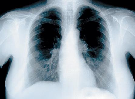 Cancerul pulmonar nu se vede la radiografie
