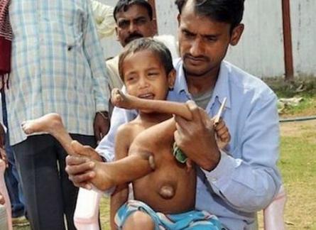 Un băieţel din India trăieşte cu membrele fratelui geamăn în piept