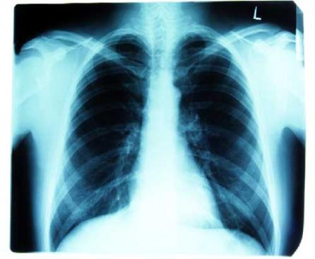 Ce ştim despre   pneumonii