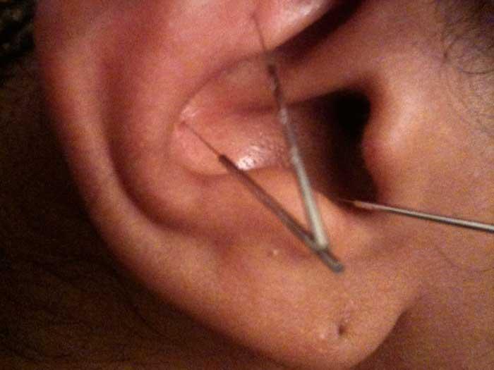Acupunctura în ureche te face mai suplu
