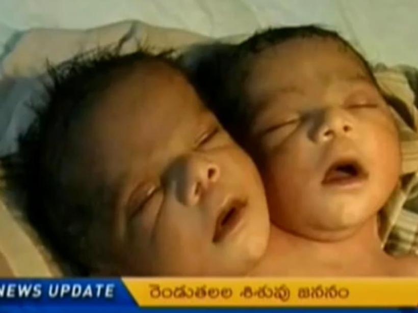 În India s-a născut un copil cu două capete!