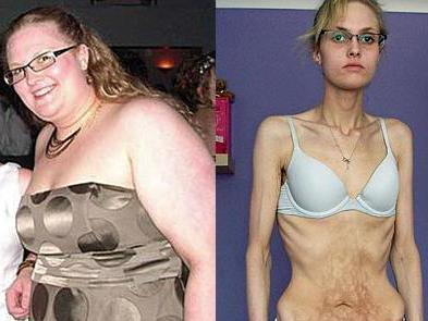 A ajuns piele şi os din cauza anorexiei!