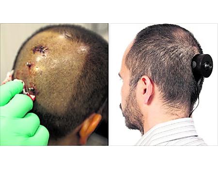 Artistul care şi-a implantat o cameră web în cap, obligat s-o scoată