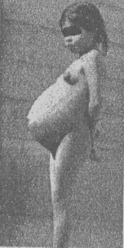 Lina Medina, cea mai tânără mamă din istorie: A născut la vârsta 5 ani! 18431552