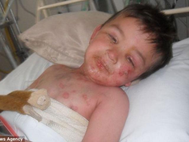 Băieţel de trei ani, aproape ucis de o reacţie alergică la Nurofen.
