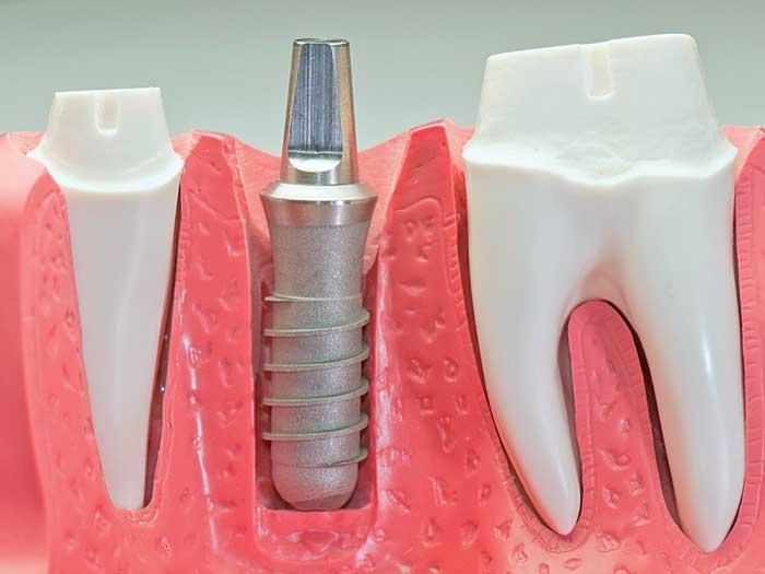 Implantul sau puntea rezolvă dintele lipsă.