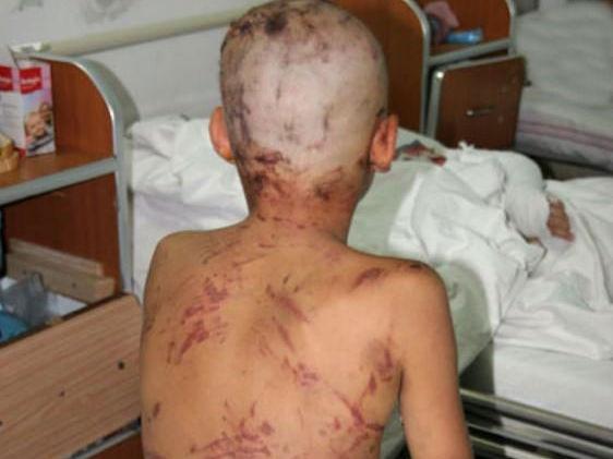 Băiat de 12 ani, mutilat de o haită de câini, în Vaslui