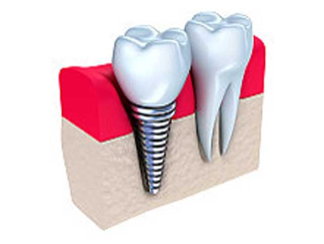 Implantul dentar, soluţia cu mănuşi