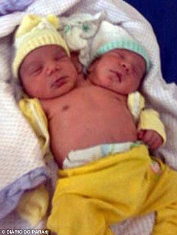 Bebeluşul cu două capete! S-a născut în Brazilia, iar medicii l-au declarat perfect sănătos