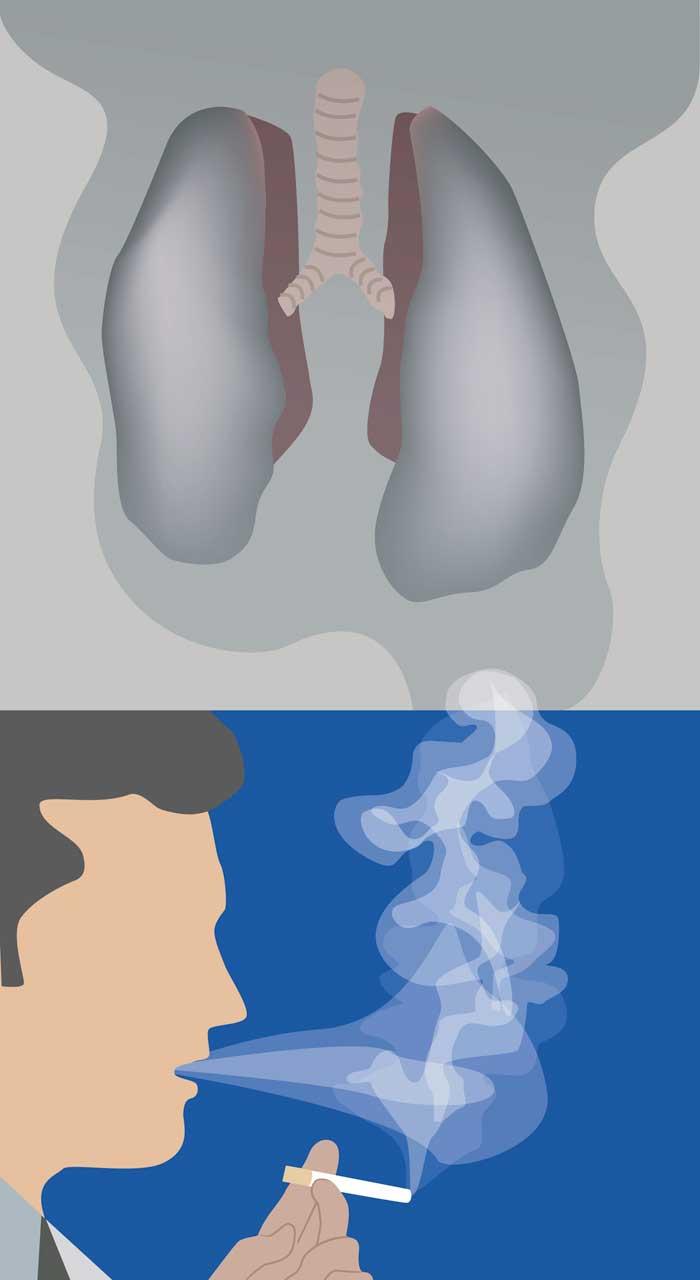 33.000 de români mor anual de cancer pulmonar