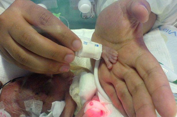 Cel mai mic bebeluş din Brazilia s-a născut cu o greutate de 340 grame!