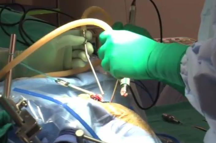 Operaţie pe creier, transmisă live pe Twitter. 14 milioane de internauţi au urmărit intervenţia chirurgilor (VIDEO)