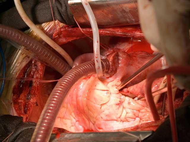 Ce este angioplastia coronariana percutanata