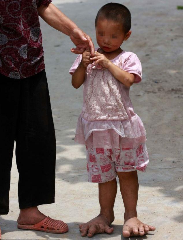 O fetiţă din China nu poate să poarte încălţăminte din cauza unei boli rare