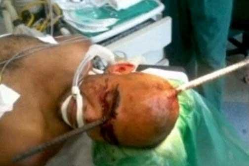 Miraculos, a supravieţuit după ce o bară de metal i-a străpuns craniul (VIDEO)