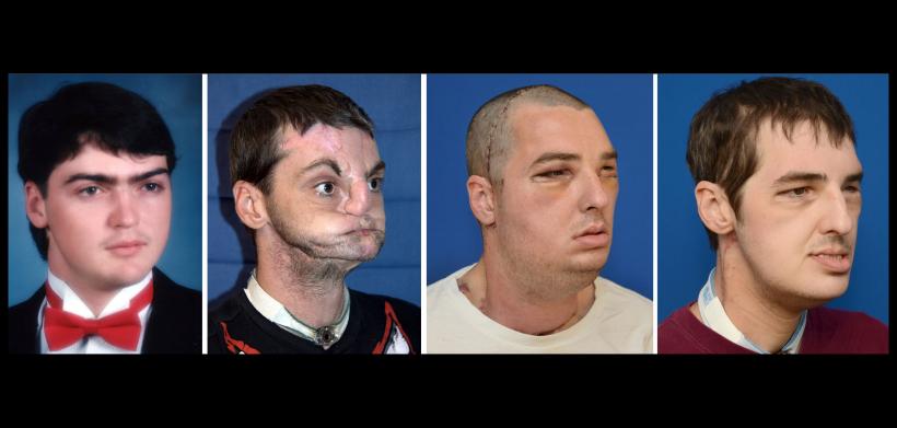 Cum arată acum primul bărbat căruia i s-a făcut un transplant de față