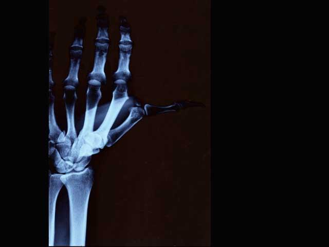 4 milioane de români suferă de artroză