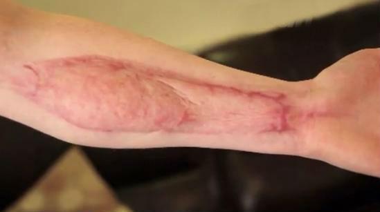 Medicii au vrut să-i taie mâna după ce a fost muşcată de un păianjen de casă, aparent inofensiv (VIDEO)