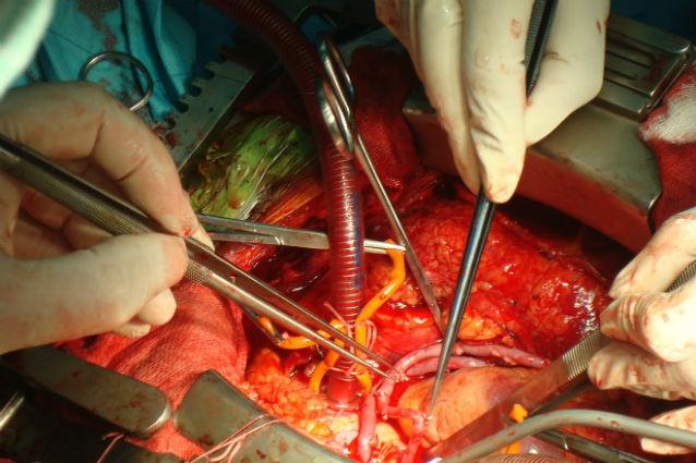 Premieră în chirurgia cardiovasculară din România, la Spitalul Monza