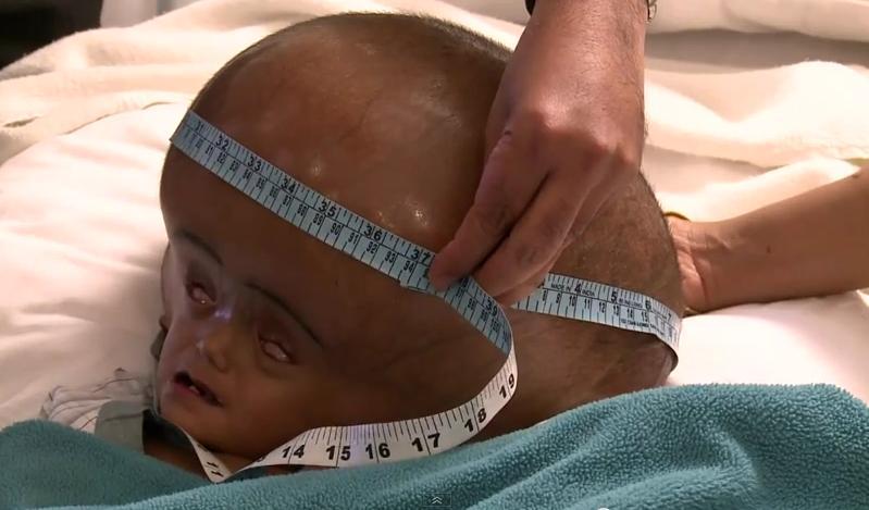Reuşită EXTRAORDINARĂ: Fetiţa cu cap de &quot;extraterestru&quot;, operată cu succes. Cum arată micuţa acum (VIDEO)