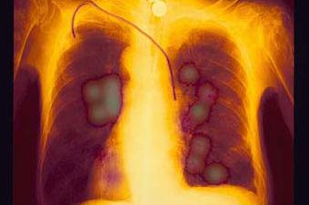 Un tratament experimental permite prelungirea vieţii în cazul bolnavilor de cancer pulmonar în fază avansată