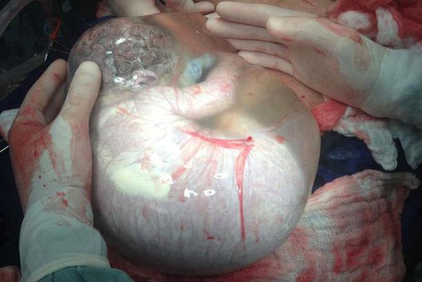 Vezi cum arată un bebeluş născut în sacul amniotic! (FOTO INCREDIBIL)