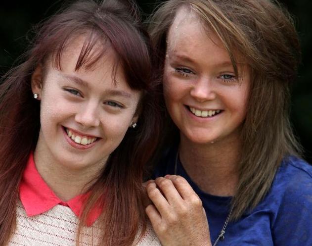 ŞOCANT: Două surori din Marea Britanie pierd 25 de kg de piele în fiecare an! Se întâmplă o dată la 600.000 de oameni