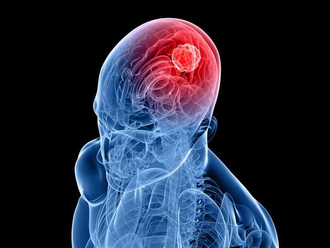 Derapaje provocate de tumorile pe creier: pierderea memoriei, a limbajului, mişcări involuntare, tulburări de vedere 