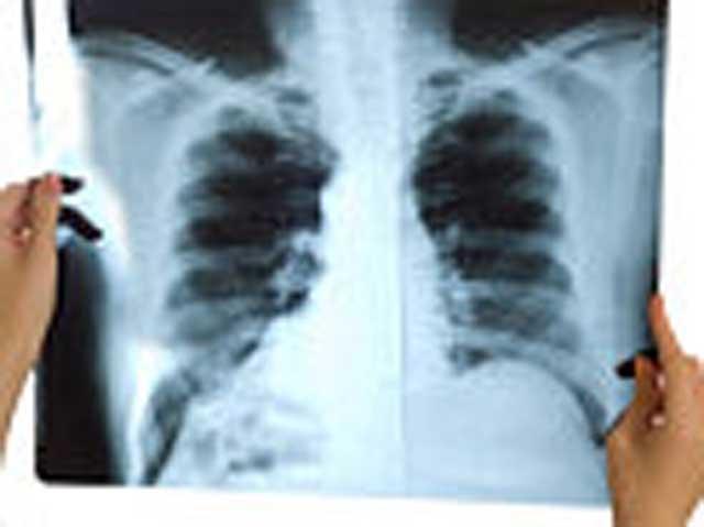 Bolile pulmonare ucid unul din zece europeni