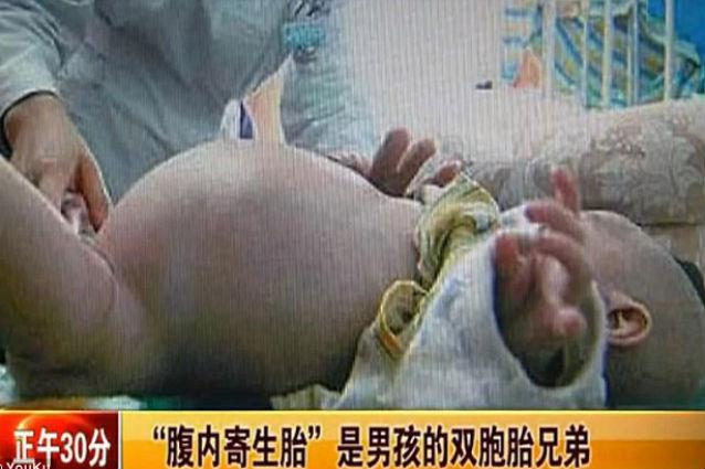 Caz medical incredibil în China: un băieţel de doi ani şi-a născut fratele geamăn! (VIDEO)