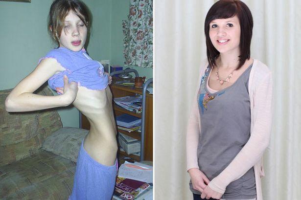 O anorexică de 25 de kilograme spune că şi-a salvat viaţa angajându-se la McDonald's