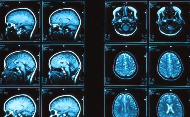 Descoperire ŞOCANTĂ: Ce a aflat un neurolog american, după ce, din întâmplare, şi-a studiat propriile RMN-uri (VIDEO)