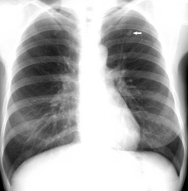 Tuberculoza, vindecabilă şi, totuşi, letală