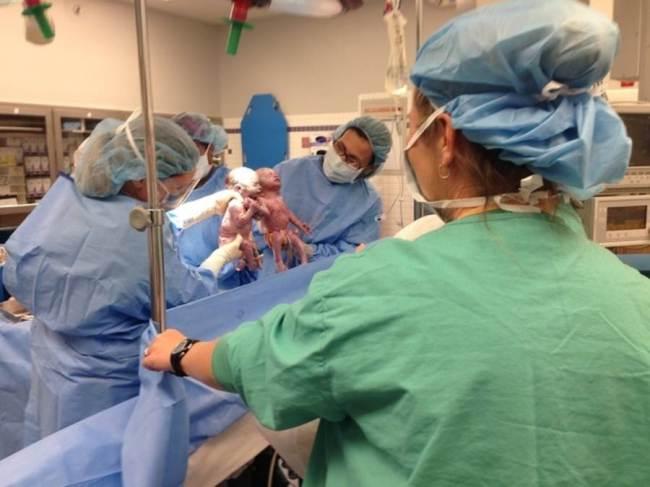 (VIDEO) Două fetiţe, gemene, diagnosticate cu o afecțiune foarte gravă, s-au născut ţinându-se de mână!
