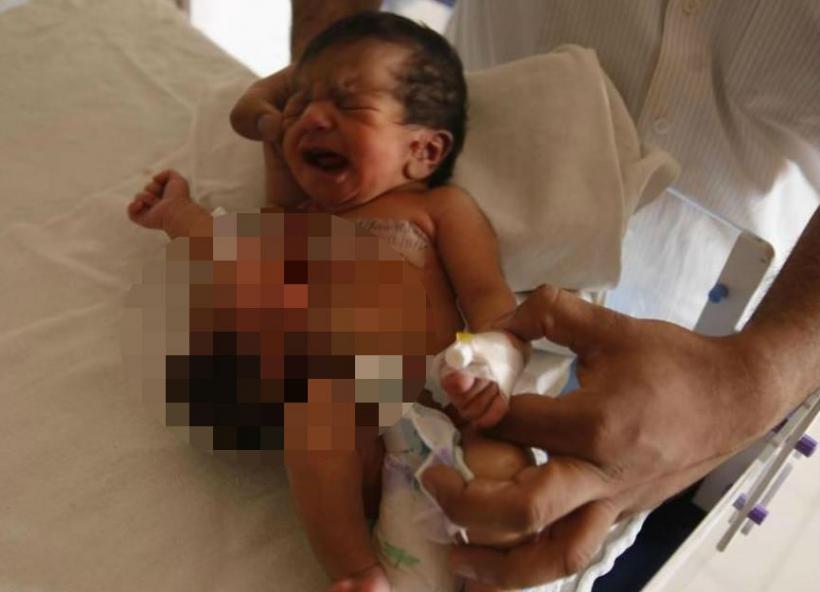 CAZ ULUITOR într-un spital din India: O fetiţă s-a născut cu un al doilea cap ataşat de stomac! (VIDEO)
