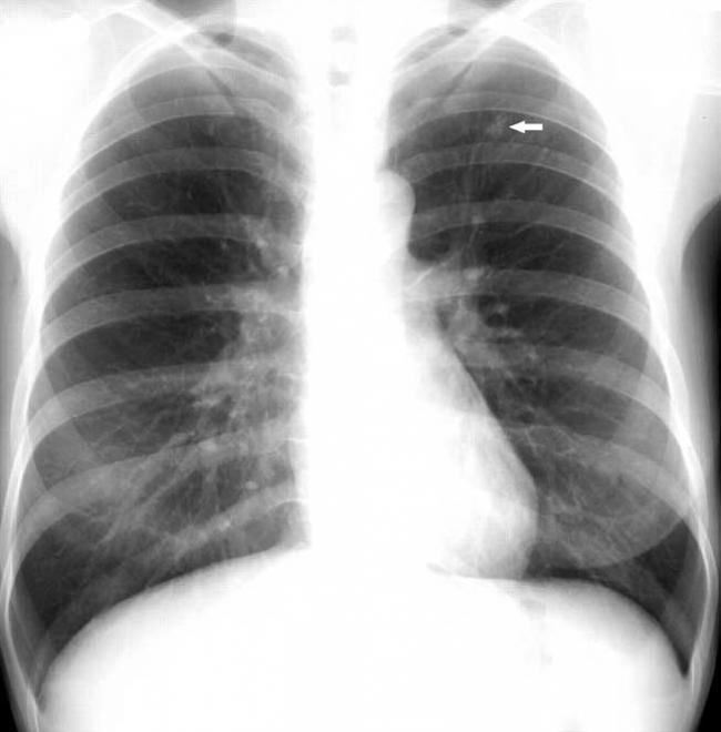 Sute de copii din Constanţa, examinaţi medical după ce un profesor de înot a fost diagnosticat cu TBC