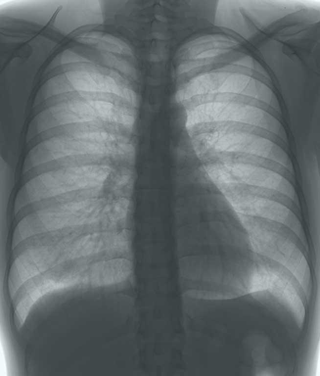 Halena arată bolile plămânului. Compuşii din aerul expirat pot indica dacă o persoană suferă de cancer pulmonar