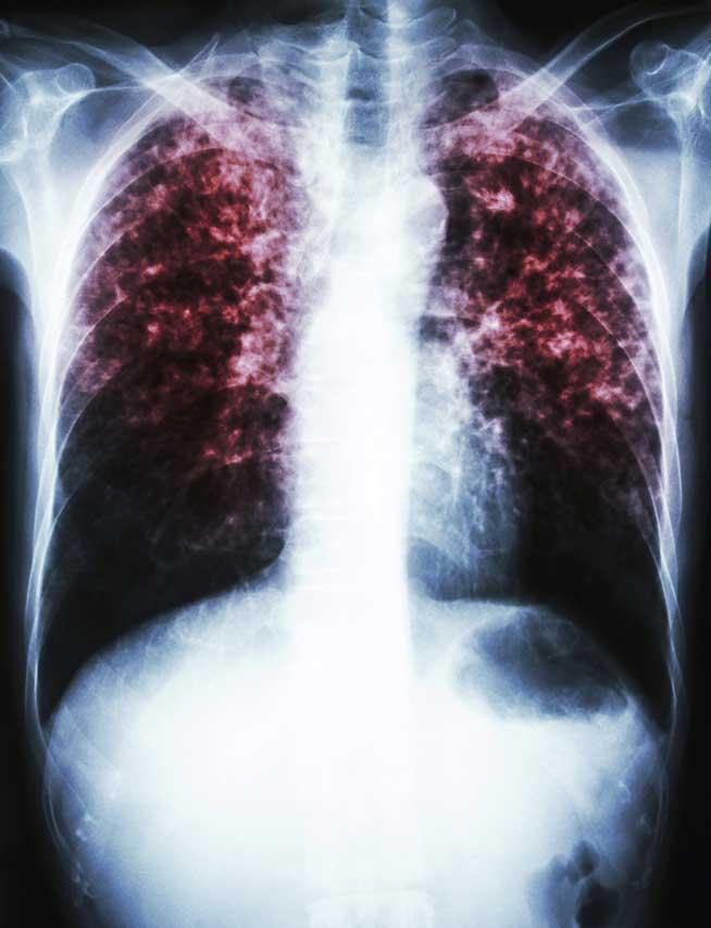 Tuberculoza multidrog, diagnosticată în două ore